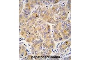 Formalin-fixed and paraffin-embedded human hepatocarcinoma tissue reacted with ALDH9A1 antibody (C-term), which was peroxidase-conjugated to the secondary antibody, followed by DAB staining. (ALDH9A1 anticorps  (C-Term))