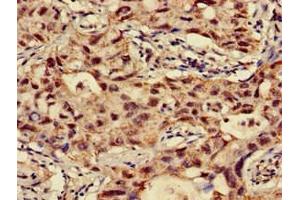 Immunohistochemistry of paraffin-embedded human lung cancer using ABIN7144675 at dilution of 1:100 (NAT1 anticorps  (AA 1-288))