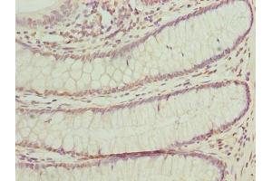Immunohistochemistry of paraffin-embedded human colon cancer using ABIN7165150 at dilution of 1:100 (BUD31 anticorps  (AA 1-144))