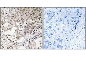 Immunohistochemistry analysis of paraffin-embedded human lung carcinoma, using NCAPG2 Antibody. (NCAPG2 anticorps  (AA 561-610))