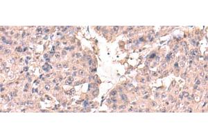 Immunohistochemistry of paraffin-embedded Human liver cancer tissue using HPN Polyclonal Antibody at dilution of 1:50(x200) (Hepsin anticorps)