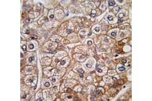 IHC analysis of FFPE human hepatocarcinoma tissue stained with BMPR2 antibody
