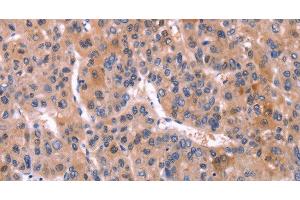 Immunohistochemistry of paraffin-embedded Human liver cancer using CD269 Polyclonal Antibody at dilution of 1:30 (BCMA anticorps)