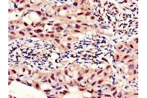 Immunohistochemistry of paraffin-embedded human lung cancer using ABIN7142693 at dilution of 1:100