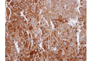 IHC-P Image Immunohistochemical analysis of paraffin-embedded human adrenal cortical tumor, using RIC8A, antibody at 1:100 dilution. (RIC8A anticorps  (C-Term))