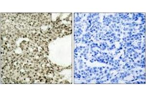 Immunohistochemistry analysis of paraffin-embedded human breast carcinoma, using STAT1 (Phospho-Ser727) Antibody. (STAT1 anticorps  (pSer727))
