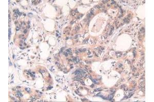 IHC-P analysis of Human Rectum Cancer Tissue, with DAB staining. (POR anticorps  (AA 77-518))