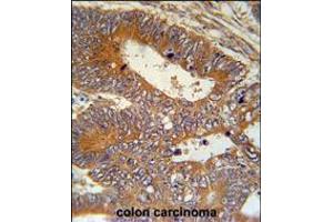 MAP1S Antibody immunohistochemistry analysis in formalin fixed and paraffin embedded human colon carcinoma followed by peroxidase conjugation of the secondary antibody and DAB staining. (MAP1S anticorps  (AA 493-520))