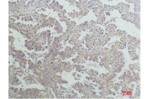 Immunohistochemistry (IHC) analysis of paraffin-embedded Human Lung Carcinoma using Nrf2 Rabbit Polyclonal Antibody diluted at 1:200.