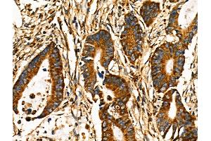 ABIN6258609 and ABIN6274191 at 1/100 staining Human colorectal cancer by IHC-P.