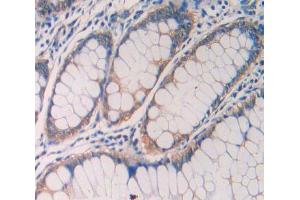 IHC-P analysis of rectum cancer tissue, with DAB staining. (IL1R1 anticorps  (AA 226-318))