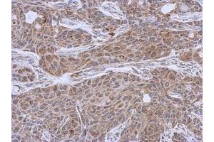 IHC-P Image Immunohistochemical analysis of paraffin-embedded Cal27 xenograft, using DLST, antibody at 1:500 dilution. (DLST anticorps  (Center))