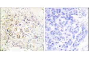 Immunohistochemistry analysis of paraffin-embedded human breast carcinoma tissue, using HER3 Antibody. (ERBB3 anticorps  (AA 1-50))