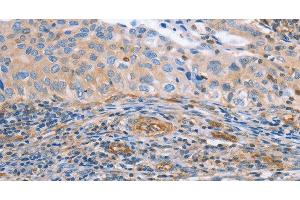 Immunohistochemistry of paraffin-embedded Human cervical cancer tissue using NRG4 Polyclonal Antibody at dilution 1:60 (Neuregulin 4 anticorps)