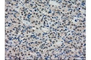 Immunohistochemical staining of paraffin-embedded Adenocarcinoma of breast tissue using anti-SCYL3 mouse monoclonal antibody. (SCYL3 anticorps)