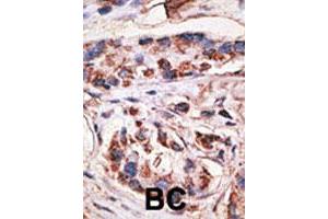 Formalin-fixed and paraffin-embedded human breast cancer tissue reacted with MAGEA1 polyclonal antibody  , which was peroxidase-conjugated to the secondary antibody, followed by DAB staining. (MAGEA1 anticorps  (Internal Region))