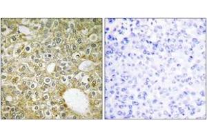 Immunohistochemistry analysis of paraffin-embedded human breast carcinoma tissue, using ACVL1 Antibody.