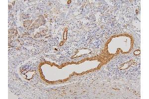 IHC analysis of RAB3GAP2 using anti-RAB3GAP2 antibody (ABIN6719633). (RAB3GAP2 anticorps  (AA 1-115))