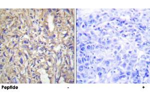 Immunohistochemistry analysis of paraffin-embedded human liver carcinoma tissue using LAMB1 polyclonal antibody . (Laminin beta 1 anticorps  (C-Term))