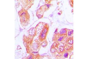 Immunohistochemical analysis of DNAJB11 staining in human lung cancer formalin fixed paraffin embedded tissue section. (DNAJB11 anticorps  (Center))