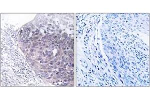 Immunohistochemistry analysis of paraffin-embedded human cervix carcinoma tissue, using GTPBP5 Antibody. (GTPBP5 anticorps  (AA 71-120))