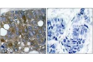 Immunohistochemistry analysis of paraffin-embedded human breast carcinoma, using HSP27 (Phospho-Ser15) Antibody.