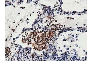 Immunohistochemical staining of paraffin-embedded Carcinoma of Human lung tissue using anti-MICAL1 mouse monoclonal antibody. (MICAL1 anticorps)