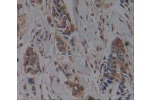 IHC-P analysis of Human Breast Cancer Tissue, with DAB staining. (HFE2 anticorps  (AA 29-401))