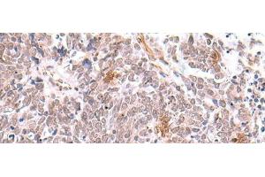 Immunohistochemistry of paraffin-embedded Human lung cancer tissue using INPP5K Polyclonal Antibody at dilution of 1:90(x200) (INPP5K anticorps)