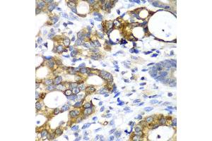 Immunohistochemistry of paraffin-embedded human gastric cancer using AMY2A antibody. (AMY2A anticorps)