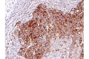 IHC-P Image Immunohistochemical analysis of paraffin-embedded SW480 xenograft, using RASGRP4 , antibody at 1:100 dilution.