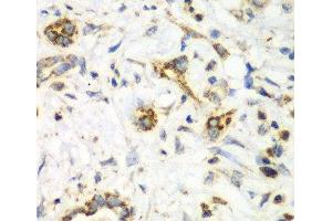 Immunohistochemistry of paraffin-embedded Human liver cancer using NRBF2 Polyclonal Antibody at dilution of 1:100 (40x lens). (NRBF2 anticorps)