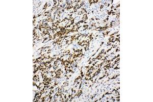Anti-DCI antibody, IHC(P) IHC(P): Human Mammary Cancer Tissue