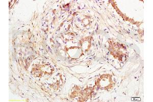 Formalin-fixed and paraffin embedded human breast carcinoma labeled with Anti-CD144/VECD/VE Cadherin Polyclonal Antibody, Unconjugated (ABIN729343) at 1:200, followed by conjugation to the secondary antibody and DAB staining (Cadherin 5 anticorps  (AA 601-700))