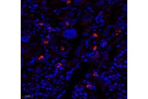Immunofluorescence of paraffin embedded human lung cancer using MTND5 (ABIN7074659) at dilution of 1: 400 (450x lens)