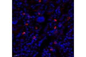 Immunofluorescence of paraffin embedded human lung cancer using MTND5 (ABIN7074659) at dilution of 1: 400 (450x lens) (MT-ND5 anticorps)
