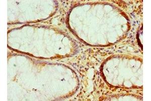 Immunohistochemistry of paraffin-embedded human colon cancer using ABIN7161681 at dilution of 1:100