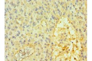 Immunohistochemistry of paraffin-embedded human glioma using ABIN7172610 at dilution of 1:100 (SOX14 anticorps  (AA 91-240))