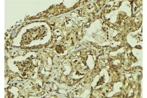 ABIN6273301 at 1/100 staining Human breast cancer tissue by IHC-P. (PPAN anticorps  (C-Term))