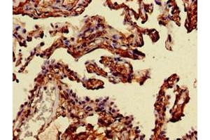 Immunohistochemistry of paraffin-embedded human lung cancer using ABIN7143899 at dilution of 1:100 (alpha-Mannosidase II anticorps  (AA 31-181))