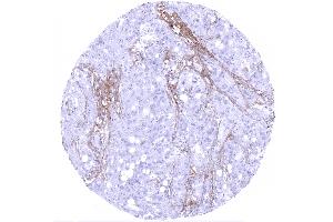 Serous high grade carcinoma of the ovary showing decorin staining of the stroma (Recombinant Decorin anticorps  (AA 212-336))