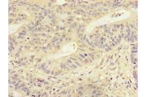 Immunohistochemistry of paraffin-embedded human colon cancer using ABIN7153118 at dilution of 1:100 (Formin-Like 3 anticorps  (AA 2-212))