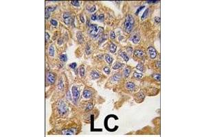 Formalin-fixed and paraffin-embedded human lung carcinoma tissue reacted with AKT2 Antibody , which was peroxidase-conjugated to the secondary antibody, followed by DAB staining. (AKT2 anticorps  (AA 452-481))