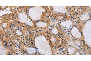 Immunohistochemistry of paraffin-embedded Human thyroid cancer tissue using ITPR1 Polyclonal Antibody at dilution 1:40