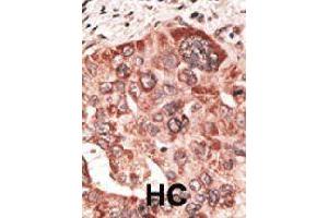Formalin-fixed and paraffin-embedded human hepatocellular carcinoma tissue reacted with RCVRN polyclonal antibody  , which was peroxidase-conjugated to the secondary antibody, followed by DAB staining. (Recoverin anticorps  (C-Term))