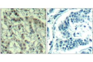 Immunohistochemical analysis of paraffin-embedded human breast carcinoma tissue using Aurora A(Phospho-Thr288) Antibody(left) or the same antibody preincubated with blocking peptide(right). (Aurora A anticorps  (pThr288))