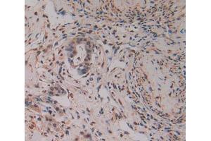 Used in DAB staining on fromalin fixed paraffin- embedded pancreas cancer tissue (PAK2 anticorps  (AA 177-419))