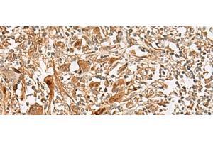 Immunohistochemistry of paraffin-embedded Human liver cancer tissue using GCC2 Polyclonal Antibody at dilution of 1:45(x200) (GCC2 anticorps)
