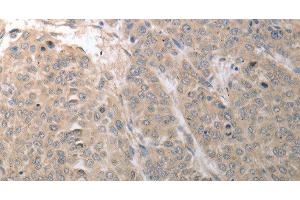 Immunohistochemistry of paraffin-embedded Human liver cancer using SLC1A4 Polyclonal Antibody at dilution of 1:70