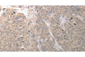 Immunohistochemistry of paraffin-embedded Human liver cancer using SLC1A4 Polyclonal Antibody at dilution of 1:70 (SLC1A4 anticorps)